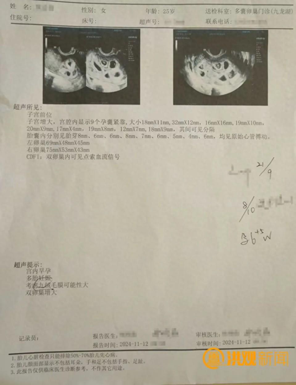 懷9胞胎女子丈夫決定減胎